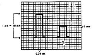 ECG Paper Vertical Axis Voltage or amplitude Measured in millivolts(mv) or millimeters (mm)