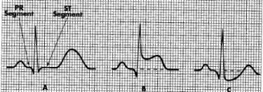 In limb leads the ST segment is normally isoelectric but may be slightly elevated or depressed by less than 1mm ST Segment In precordial