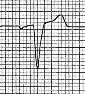 11 121 Right Bundle Branch Block Causes CAD Disease of right side of