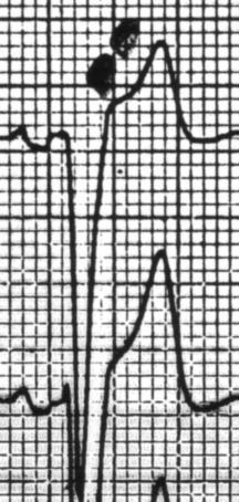 have injury - frown 131 Left Bundle Branch Block Often have left axis deviation From
