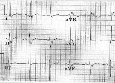 Left Anterior Hemiblock Lead 2, Lead 3 and avf rs pattern Small r waves Slightly wide / deep S waves Increased limb lead voltage Lead 1 and avl qr pattern Normal QRS duration 135 Lead 1 Left Arm High