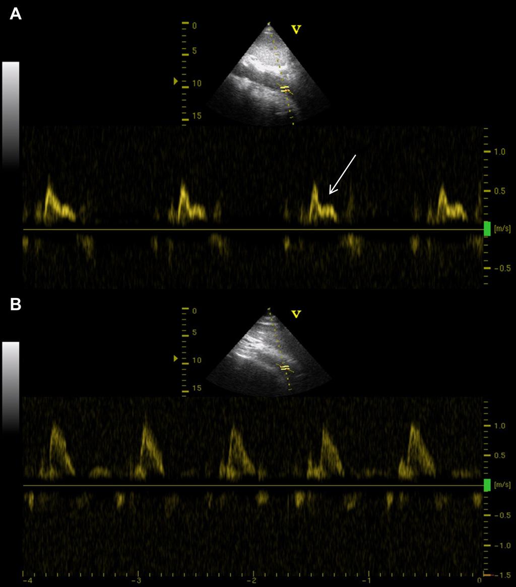 716 G. Styczynski et al. Figure 1 Proximal abdominal aortic waveform. Panel A e mid-systolic deceleration (arrow) in patient with aorto-iliac disease.