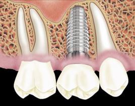 5 mm of bone on the lateral aspects of the implant body 1.5 mm 3 mm Ideal implant size When the facial bone (bacco-oral) thickness is inferior to 1.4 mm Bone loss may result 1.