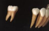 J Periodontal Dent 2004;92:434-440 When possible, a larger diameter implant or two splinted traditional size implants should be inserted to enhance the mechanical properties of the implant.