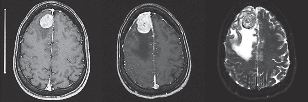 Fig. 1. An illustrative case of failed radiosurgery treatment.
