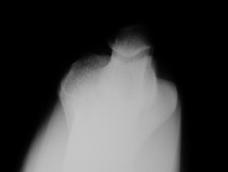 Slide 22 Plain X-Rays Plain Radiographs AP, Lat,