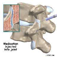 this occurs in the facet joints it can cause back pain. In addition to back pain, the pain may radiate into the buttock and back of the thigh.