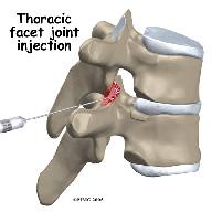 During a facet joint injection, the medications that are normally injected include a local anesthetic and cortisone.