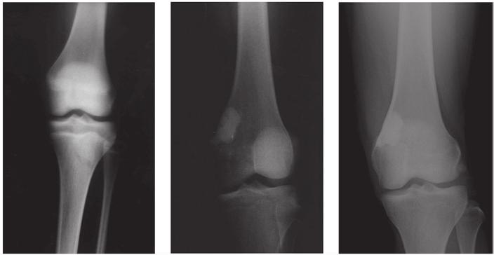 ONCOLOGY LETTERS 11: 247-252, 2016 249 A B C Figure 1. Radiograph showing non ossifying fibroma of the left distal femur (case 20). (A) The tumor was located in the distal part of femur.