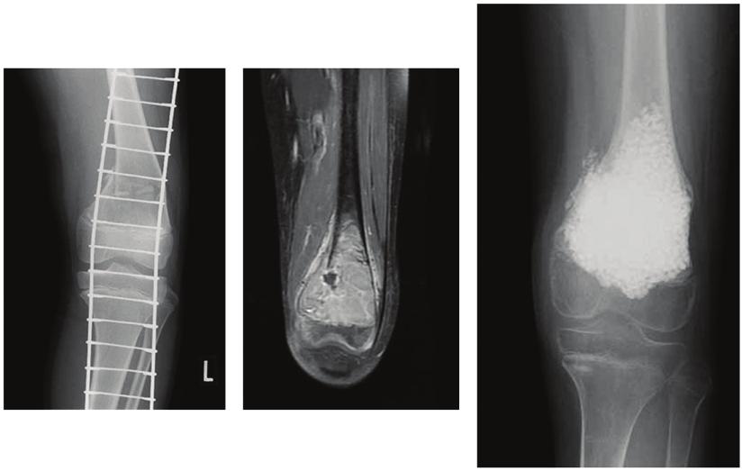 ONCOLOGY LETTERS 11: 247-252, 2016 251 A B C Figure 2. Radiograph showing recurrent giant cell tumor of the right proximal femur (case 28).