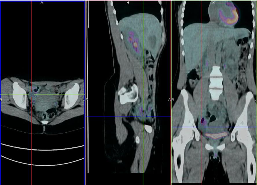 308 Gynecol Surg (2011) 8:305 309 Fig. 3 Patient 2 with no relevant PET findings PET scan did not demonstrate all extensions of the disease in any of the cases.