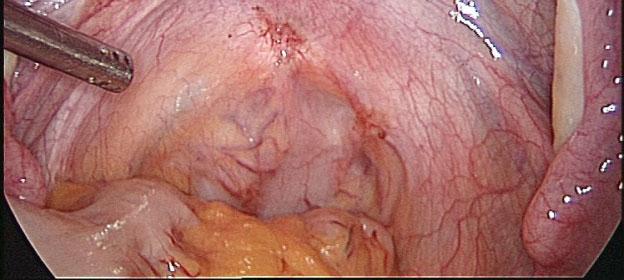 nodule first Excision of the vagina
