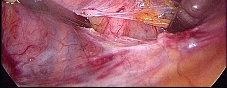 para rectal area on both sides Dissection of