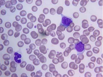 Persistent lymphocytosis consisting of small Lymph node aspirates containing an excess of small,