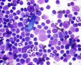 Classic Thymoma: Mast cells Thymoma: Mixed population of