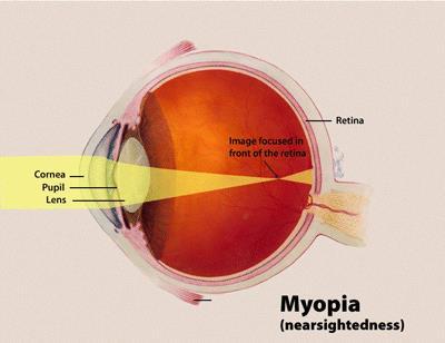 Diseases of the Eye Myopia: Near-Sightedness (Can t see distance) Eyeball is too long causing light to