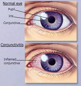 Conjunctivitis Pink Eye Inflammation of the conjunctiva (clear membrane covering the