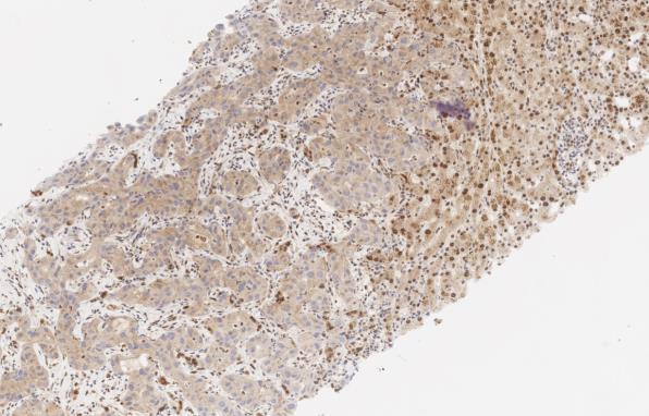 BAP1: loss in tumor cells BAP1 loss