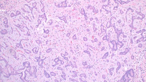 Cholangiolocellular carcinoma Histologic criteria for diagnosis Study Microscopic Description Inconsistencies Kozaka, 2007 small tubular or acinar or cord-like structures, resembling reactive bile