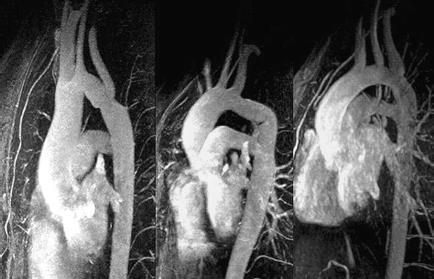 Aortic Arch Morphology