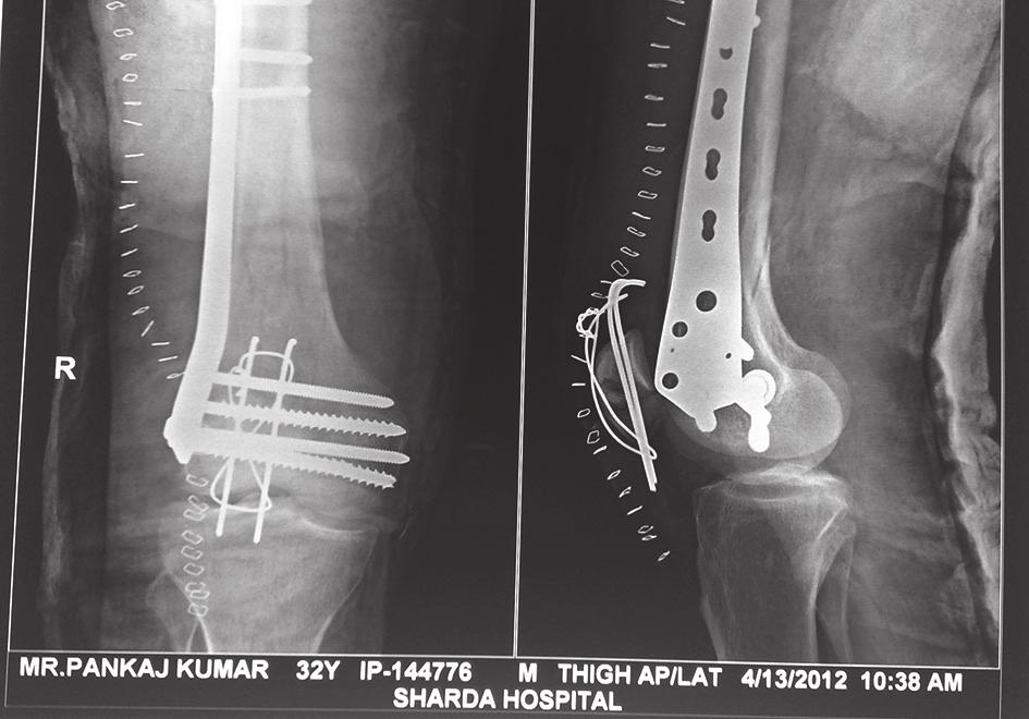 MATERIALS AND METHODS This prospective study was carried out at Orthopaedics department of School of Medical Sciences and Research, Sharda University from December 2010 to December 2014.