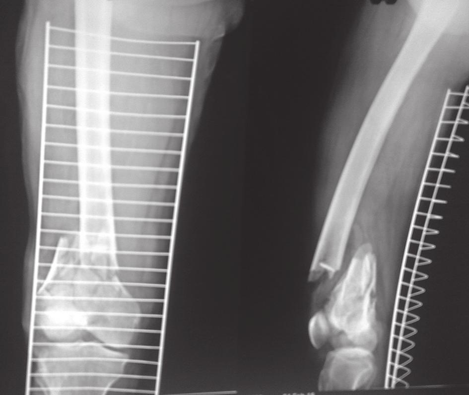 functional outcome following internal fixation of intraarticular fractures Fig. 2a. Preoperative AP and Lateral radiograph of intraarticular fracture of lower end of femur of 48 years old man.
