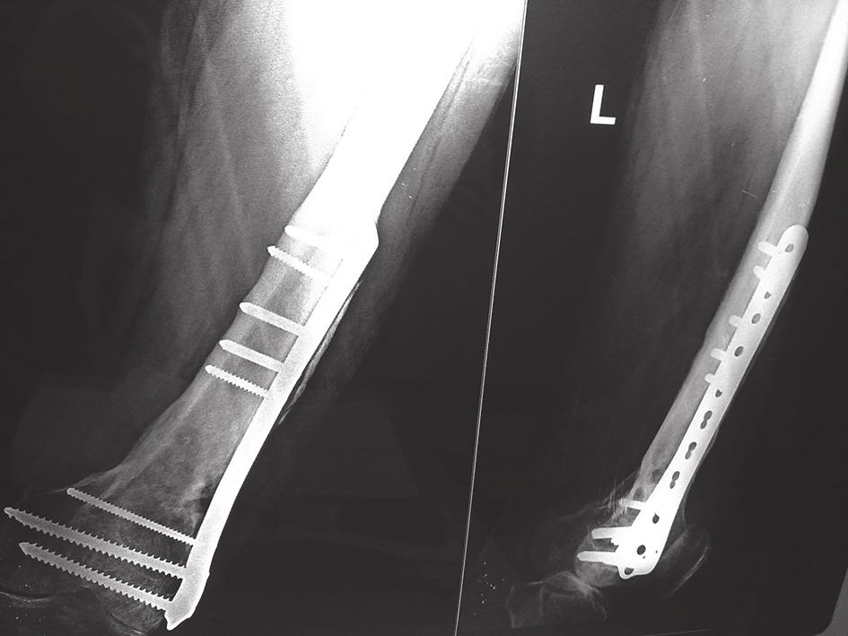 Follow-up case of intraarticular fracture of lower end of femur showing flexion of knee. Fig. 2b.