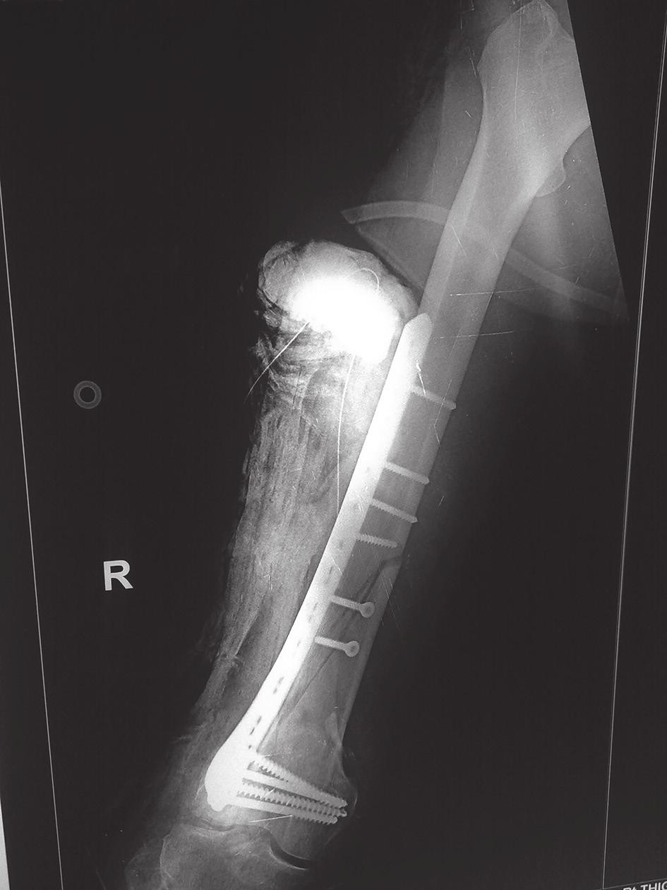 Post operative AP radiograph of intraarticular fracture of lower end of femur treated with locking distal femur plating. locking compression plates.