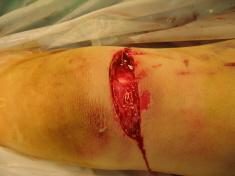 clean wound edges Cut fat back to punctuate bleeding