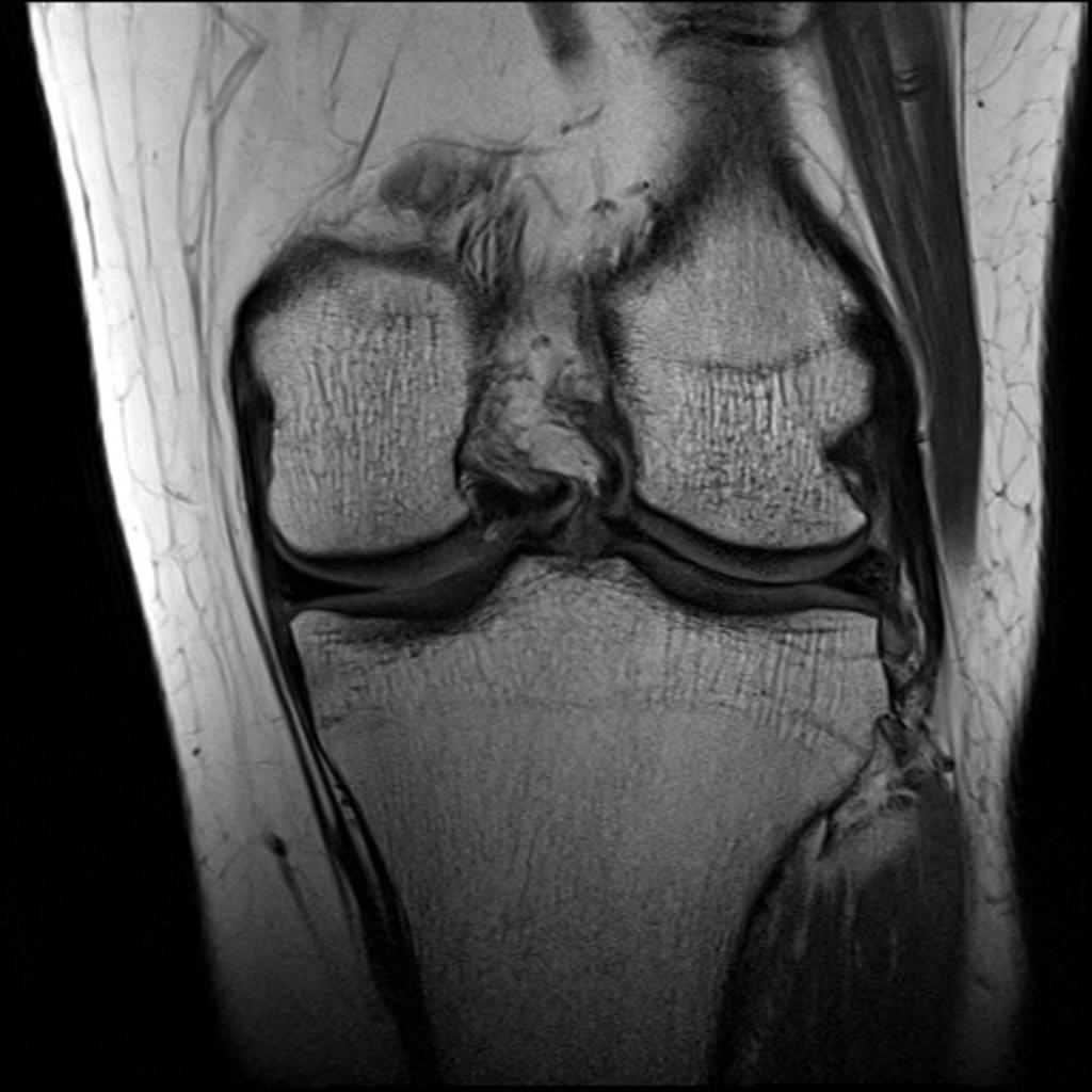 Fig. 2: Coronal PD image showing a discoid lateral meniscus covering