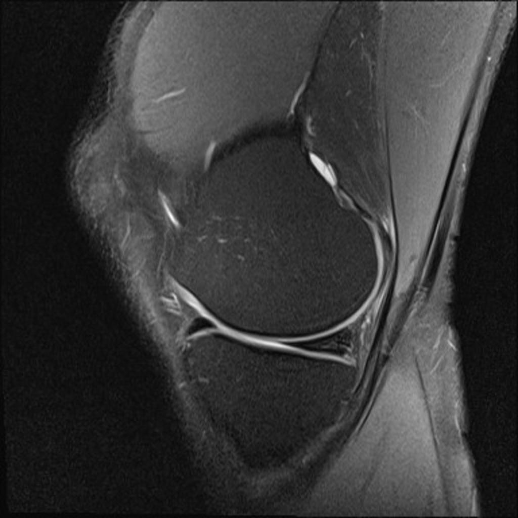 Fig. 3: Non surfacing signal in the posterior horn of medial meniscus in this sag
