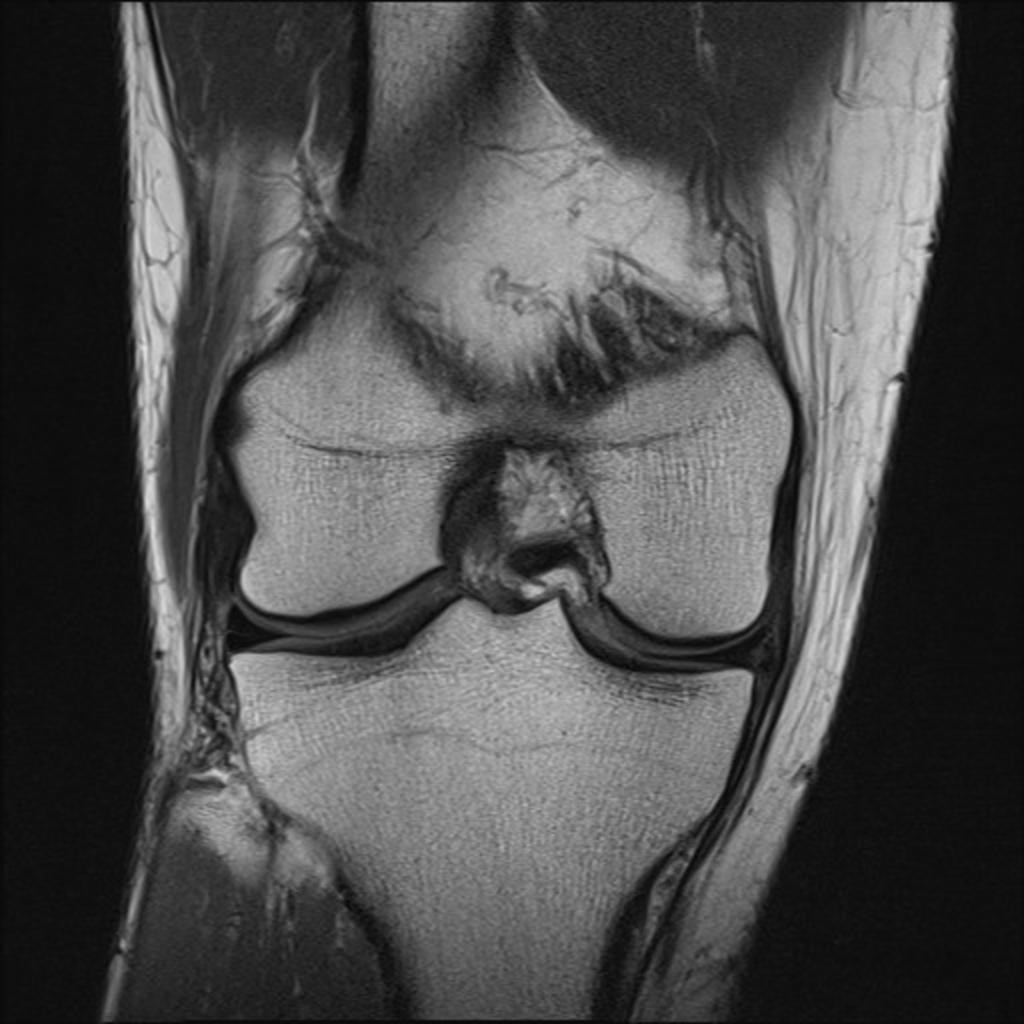 Fig. 5: Coronal PD image demonstrating a peripheral vertical tear