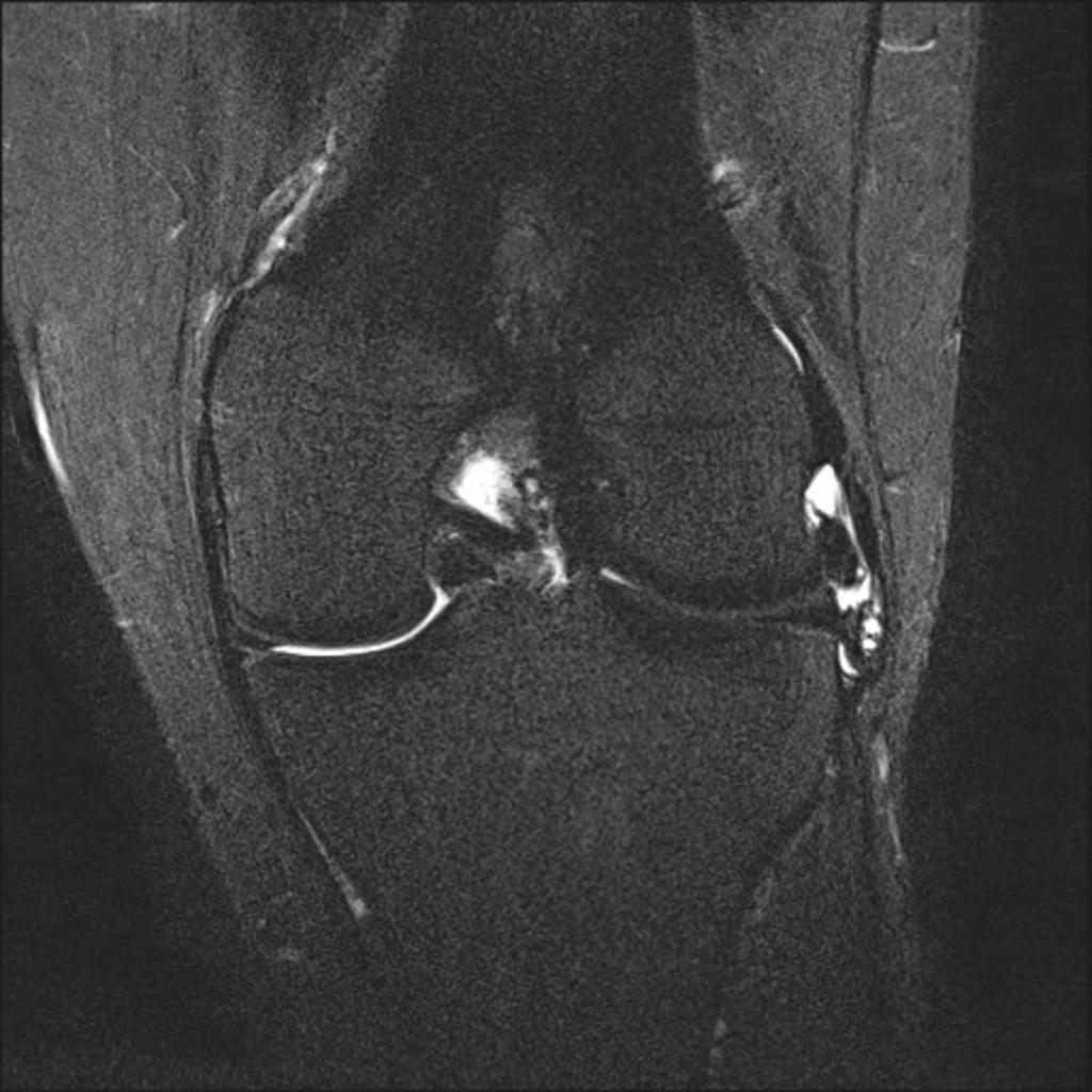 Fig. 8: Bucket handle tear of the medial meniscus.