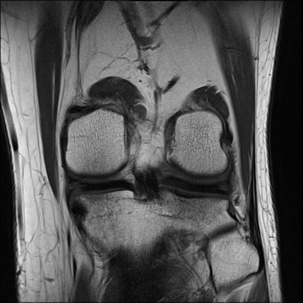 Fig. 10: Menisco capsular junction tear involving the posterior