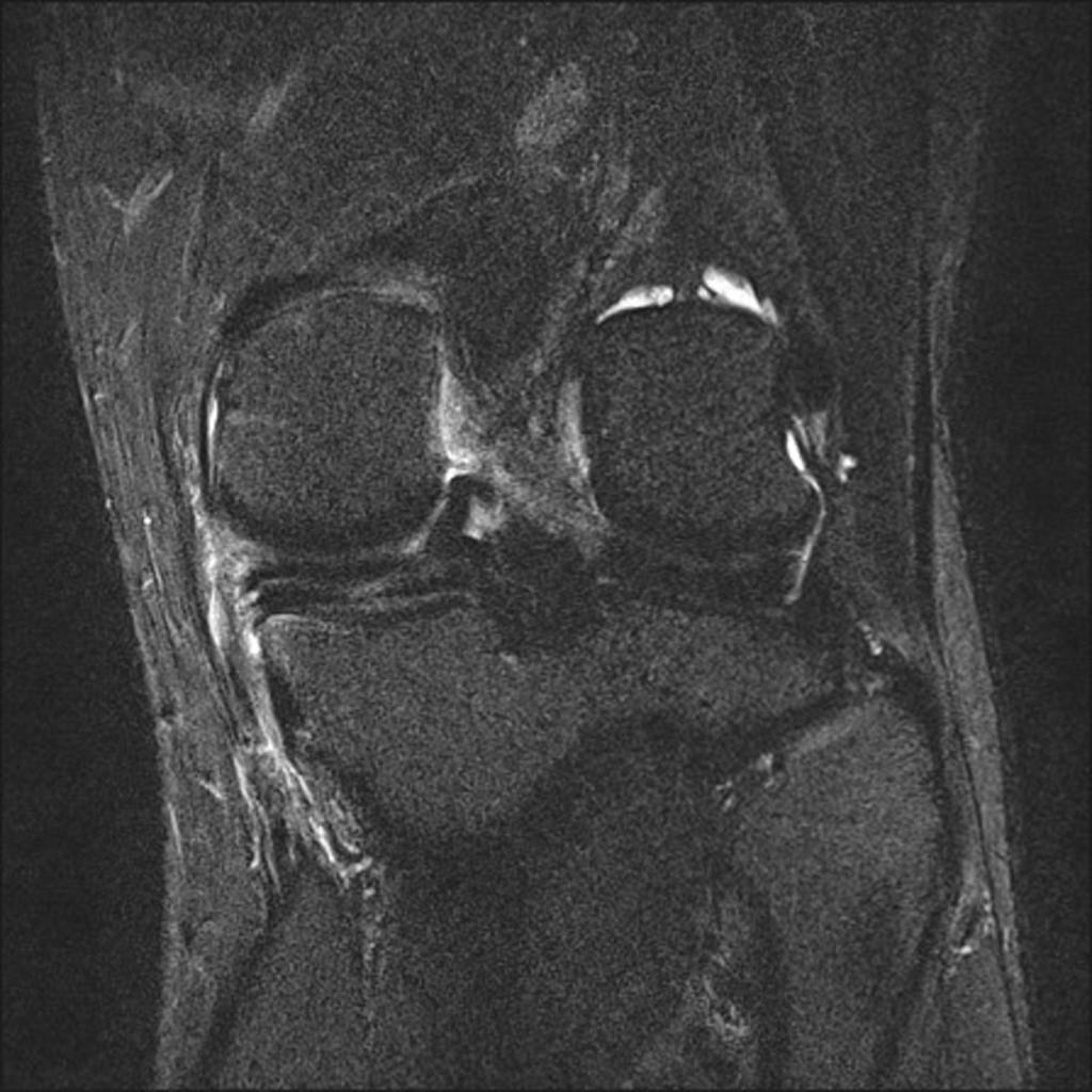 Fig. 12: Flap tear involving the posterior horn of medial meniscus.