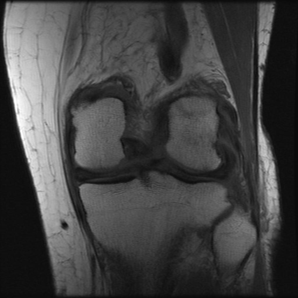 Fig. 15: Vertical tear of the lateral meniscus
