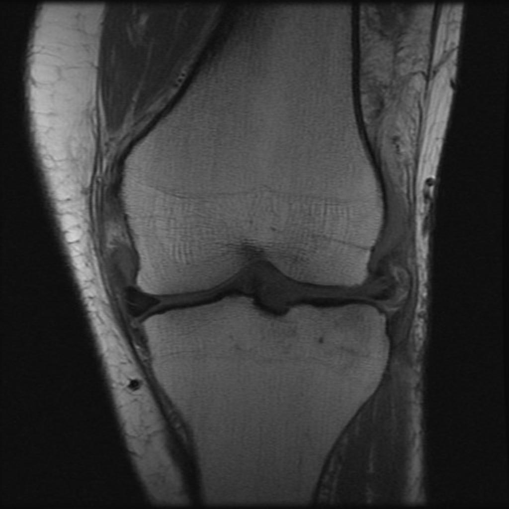 Fig. 16: A more anterior coronal image from the same patient with lateral