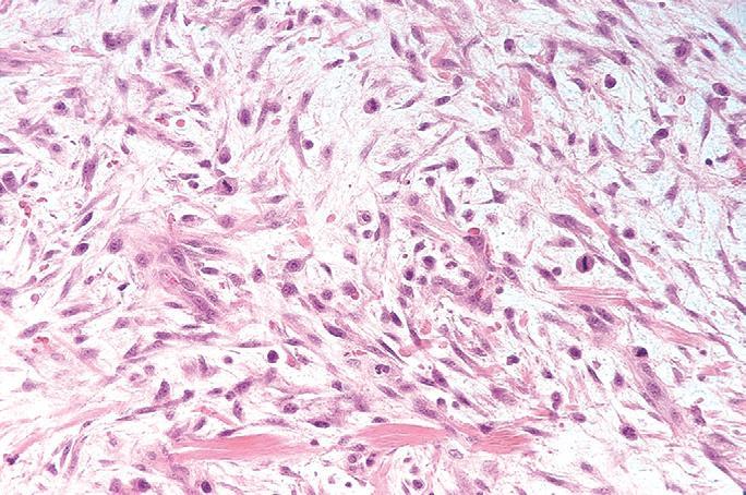 Fibrous Tumors & Reactive Proliferations: 1- Nodular fasciitis: reactive lesion Fasciitis: inflammation of the fascia, although it is a proliferative lesion.