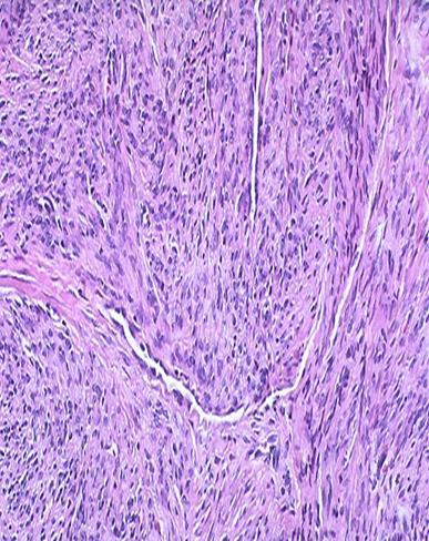 Desmoid tumor: infiltrative; you can see spindle cells infiltrating the muscle and the fat.