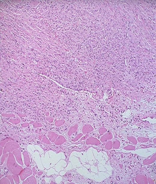 3-Fibrosarcoma: Malignant form of fibrous lesions. Mostly affects adults Sites: Deep soft tissues (thighs), knees and retroperitoneum.