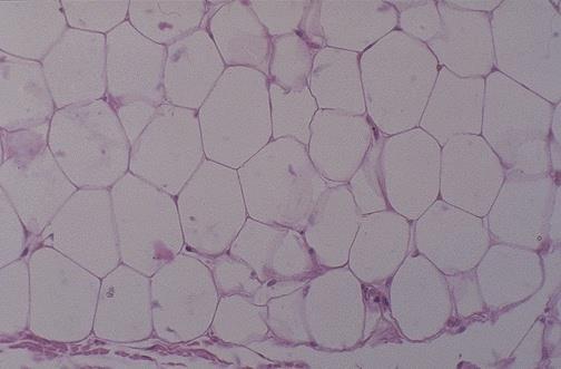 Lipoma: Mature fat cells.