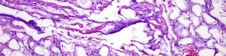 lipoma mast cells Pleomorphic