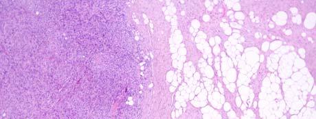 Dedifferentiated Liposarcoma A confluent focus of high grade sarcoma arising within or adjacent to a WDLS. No size criteria.