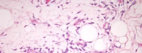Diagnosis Myxoid Liposarcoma Case An incidental