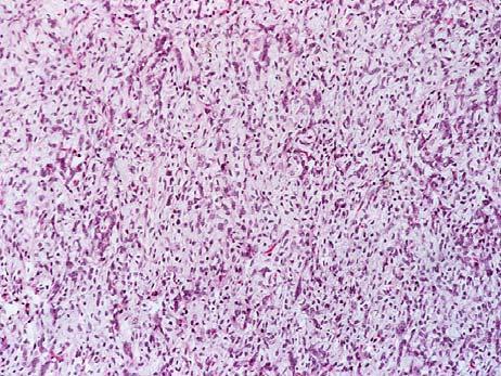 Transitional Myxoid/Round Cell Liposarcoma Partial preservation of