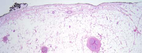 lesion attached to a large nerve with fibrosis Often