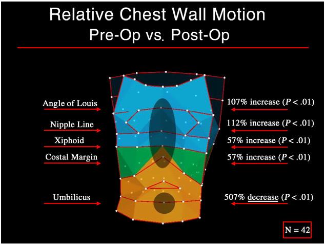 Optoelectronic pletysmography Fig. 2 Relative chest wall excursion PE vs PO.