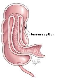 Intussusception- a surgical abdomen invagination of one part of intestine into itself age < 1 year, neonates seldom etiology: 90% idiopathic = unknown (2-7%)- viral infection with Peyer s patches