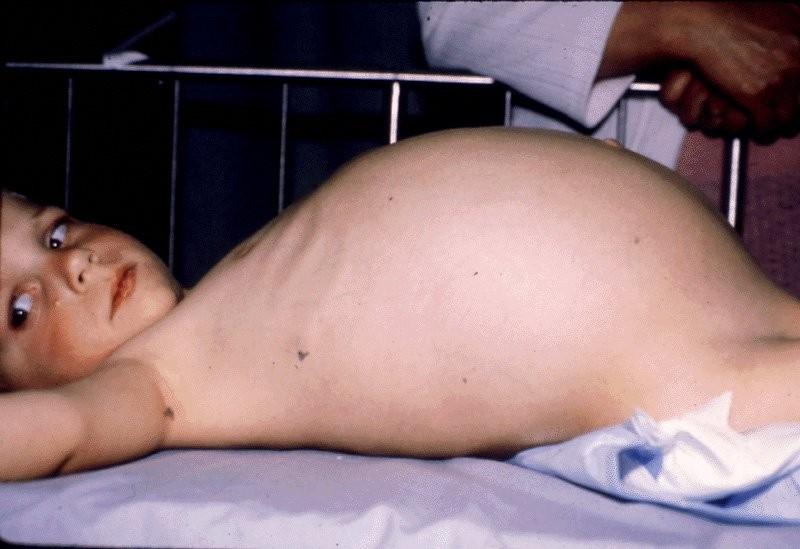 Hirschprung disease- abdomen
