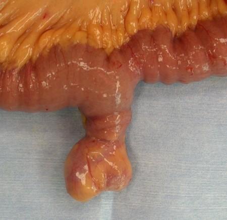 tissue: gastric and pancreatic Symptoms: asymptomatic, (2% symptomatic)- most < 2 yrs of life, hemorrhage, intussusception, volvulus,